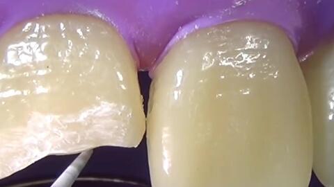 成人大门牙修补视频,视频教程解析与实操技巧